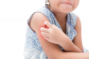 alergia-a-las-picaduras-de-mosquitos